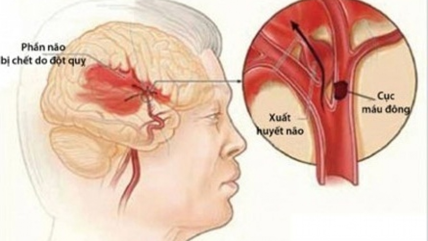 Rét đậm, rét hại cẩn trọng đột quỵ não